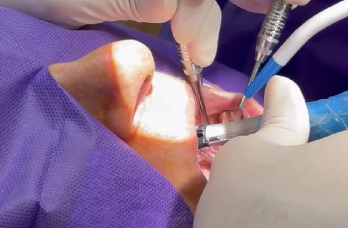 Chirurgie implantaire Chirurgie implantaire